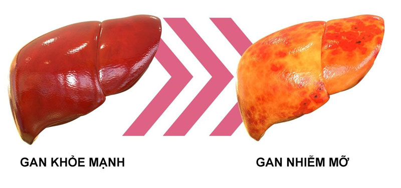 Gan nhiễm mỡ là gì?