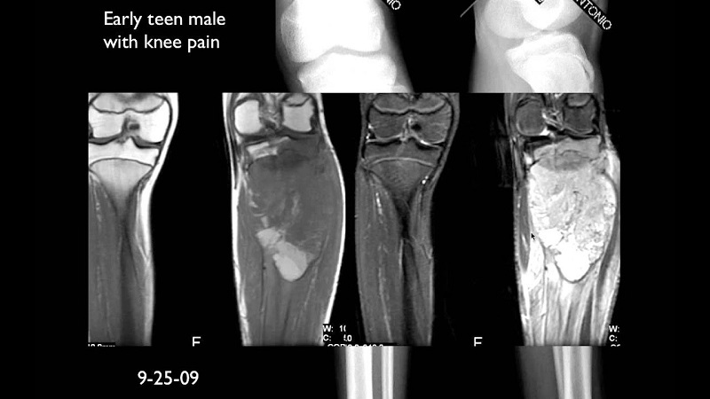 Hình ảnh chụp MRI xương khớp