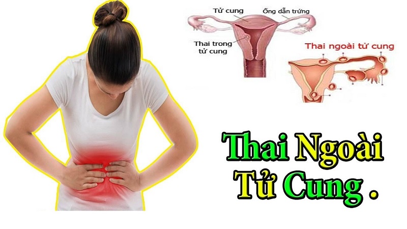 Đau bụng kéo dài có thể là dấu hiệu cảnh báo bạn đang mang thai ngoài tử cung