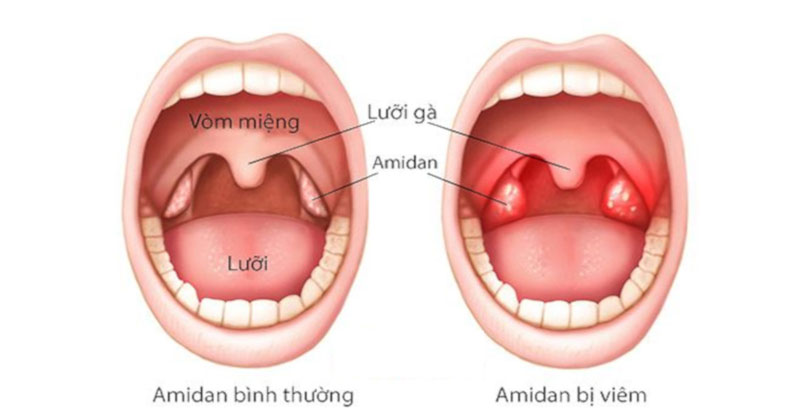 Trẻ em là đối tượng rất dễ mắc bệnh viêm amidan.