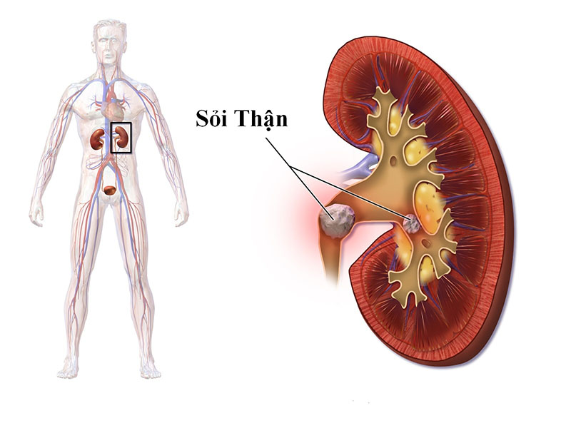 Sỏi thận có thể là một trong những nguyên nhân khiến thận suy giảm chức năng