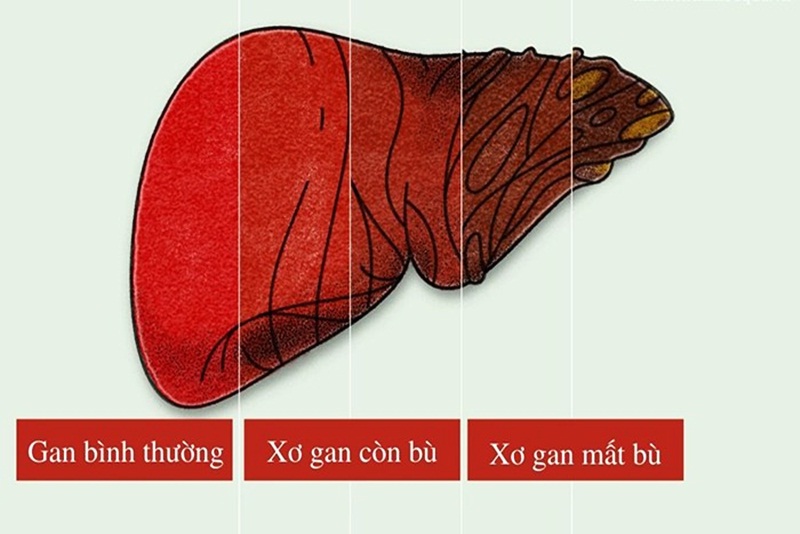 Xơ gan mất bù là giai đoạn cuối xơ gan