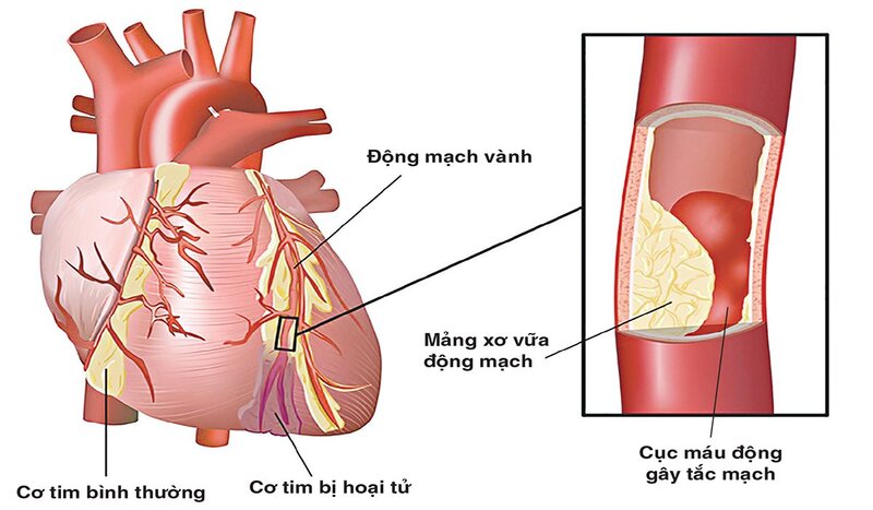 Biến chứng mạch máu lớn do đái tháo đường là hậu quả của xơ vữa động mạch