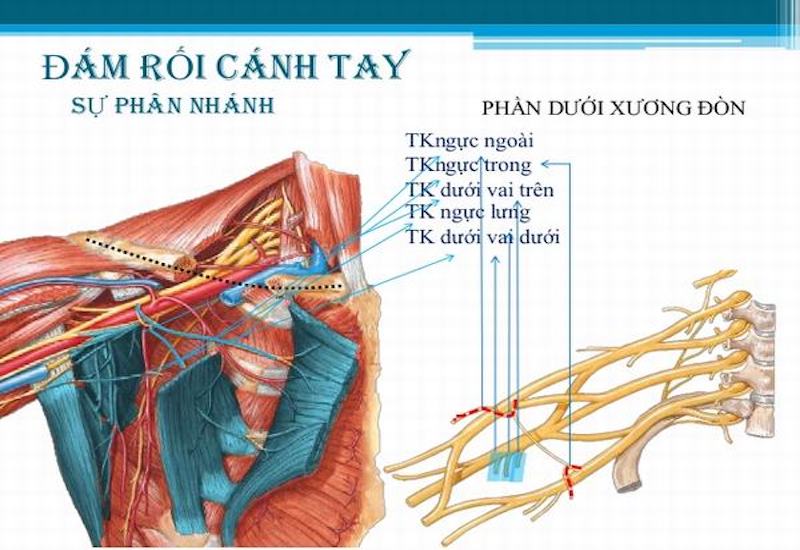 Bệnh lý đám rối cánh tay là một dạng của teo cơ thần kinh 