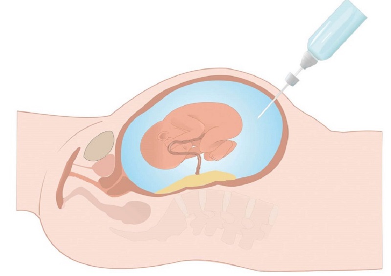 Sau kết quả xét nghiệm sàng lọc NIPT phát hiện bất thường, mẹ bầu nên chọc ối làm nhiễm sắc thể đồ