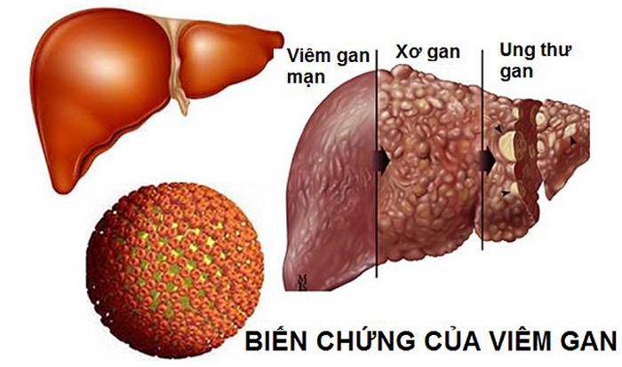 Bệnh viêm gan B nguy hiểm do tốc độ lây lan nhanh và có thể biến chứng thành xơ gan, ung thư gan khi ở giai đoạn mãn tính