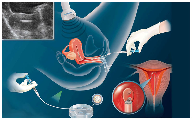 Cần chuẩn bị gì khi thực hiện bơm tinh trùng IUI 