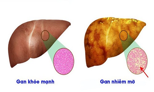 Nếu không được điều trị sớm bệnh gan nhiễm mỡ dễ chuyển biến xấu