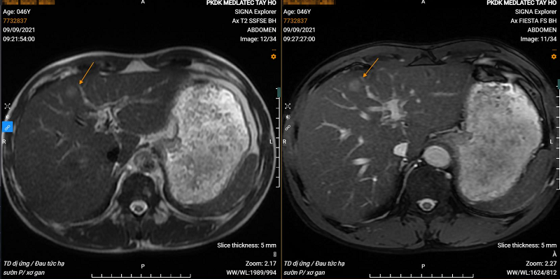 Hình ảnh khối u gan trái trên phim chụp MRI của bệnh nhân