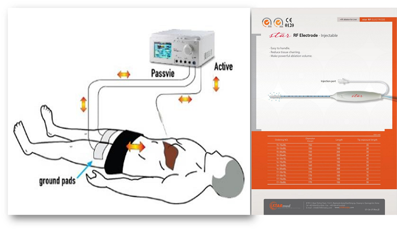 Kỹ thuật RFA dùng sóng cao tần để phá hủy khối u tại chỗ