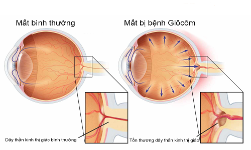 Mắt bị bệnh glocom