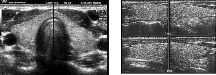 Siêu âm tuyến giáp, nhanh chóng, chính xác tại Bệnh viện đa khoa MEDLATEC