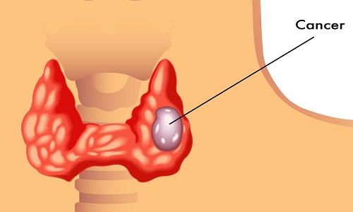 U tuyến giáp cũng được chia làm 2 loại là lành tính và ác tính