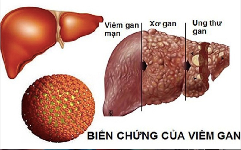 Viêm gan B là bệnh nguy hiểm