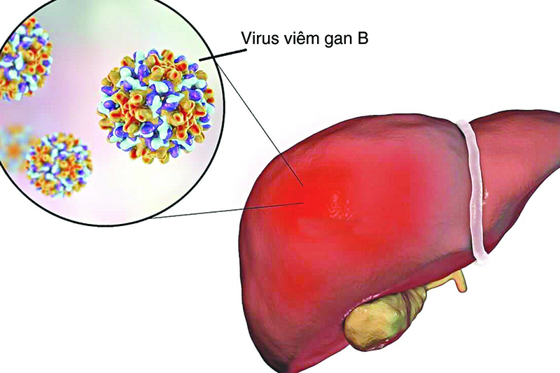 Viêm gan B - sát thủ thầm lặng đe dọa đến tính mạng người nhiễm bệnh