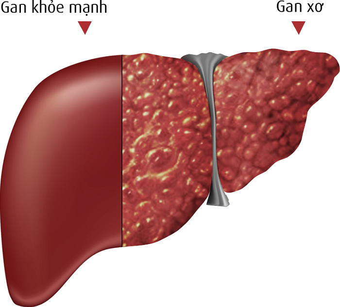 Xơ gan giai đoạn F3