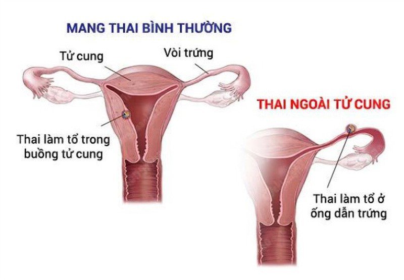 Viêm vùng chậu không được điều trị có thể dẫn đến mang thai ngoài tử cung