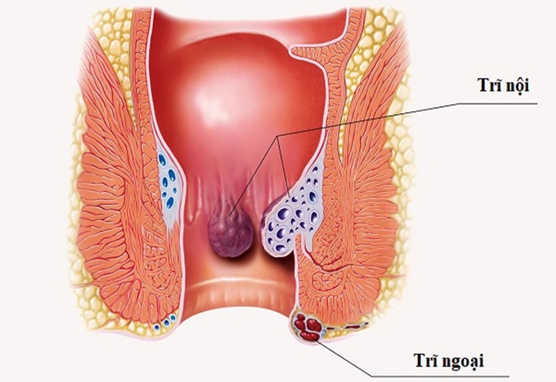 Phân có lẫn máu có thể do bệnh trĩ