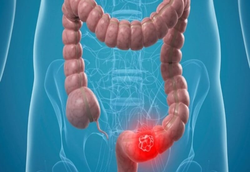 Phân có lẫn máu có thể do bệnh Crohn