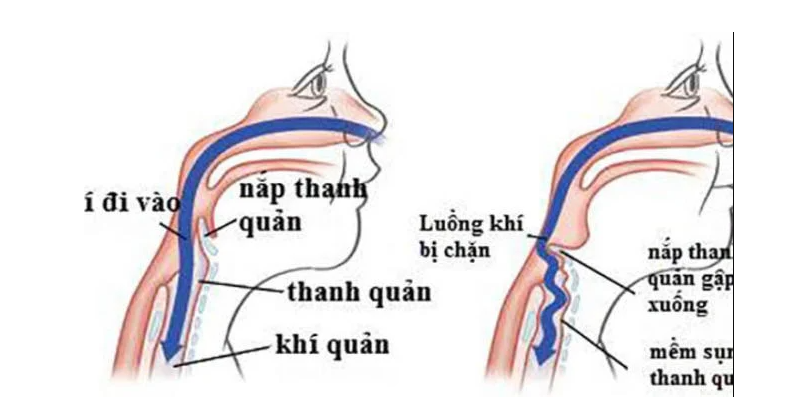 Mô phỏng nguyên nhân gây thở rít ở trẻ