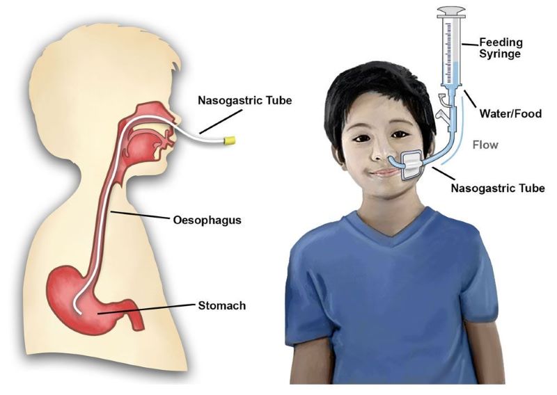 Đặt ống thông dạ dày có thể theo đường mũi hoặc đường miệng