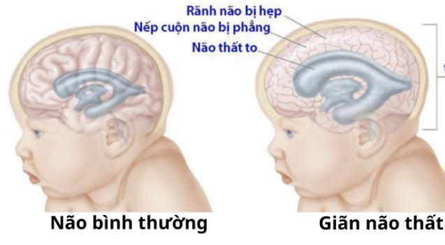 giãn não thất bên ở thai nhi