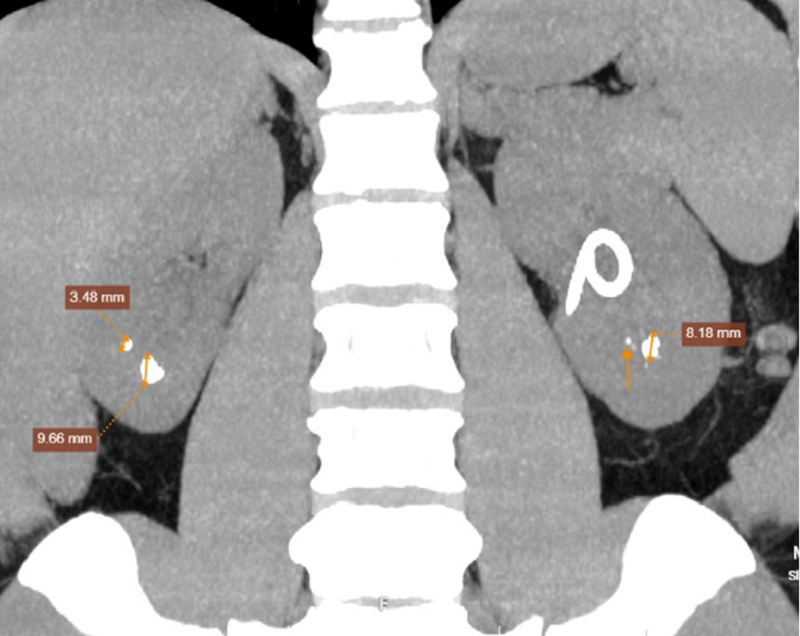 Chụp CT hệ tiết niệu hình ảnh sỏi niệu quản trái đoạn 1/3 giữa, sỏi thận hai bên