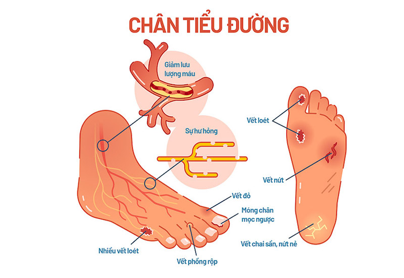 Biến chứng bàn chân tiểu đường