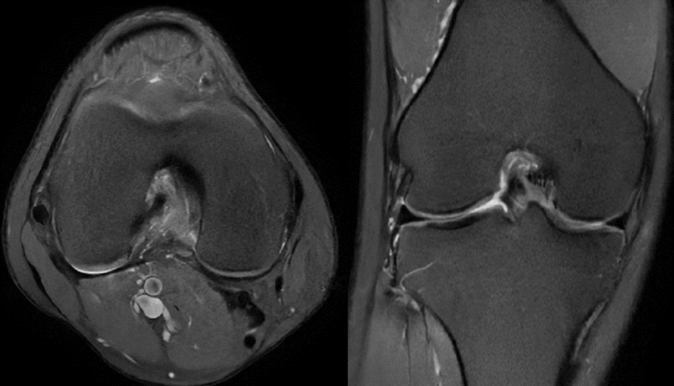 Chụp MRI