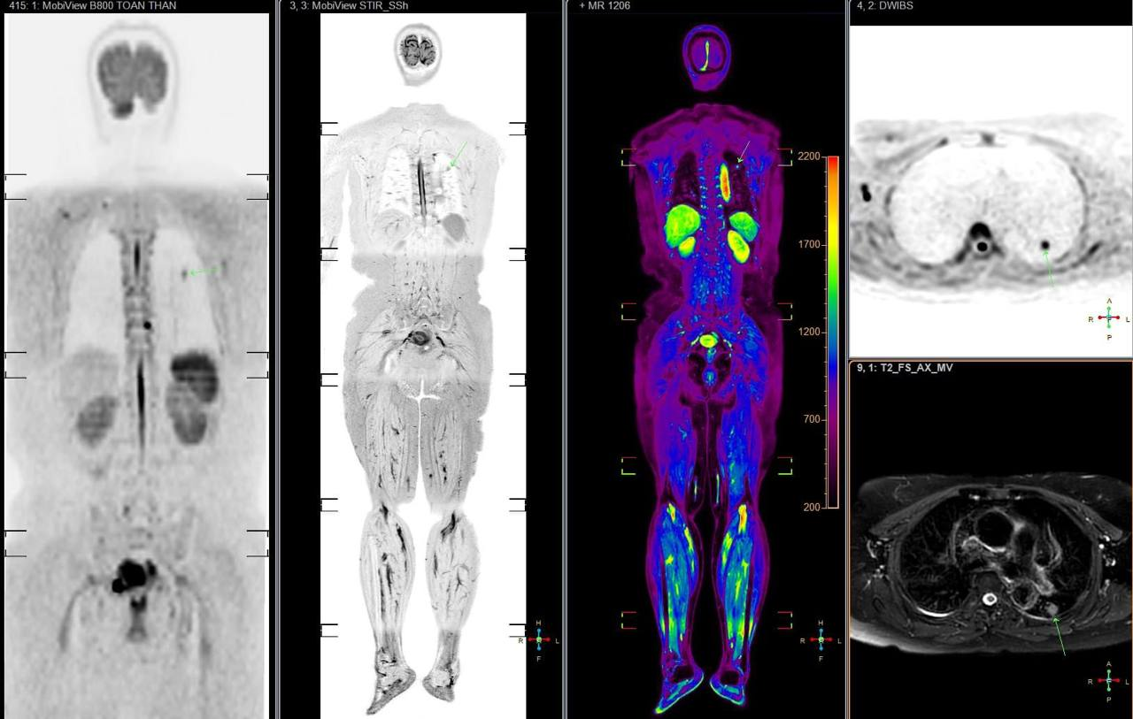 chụp MRI toàn thân