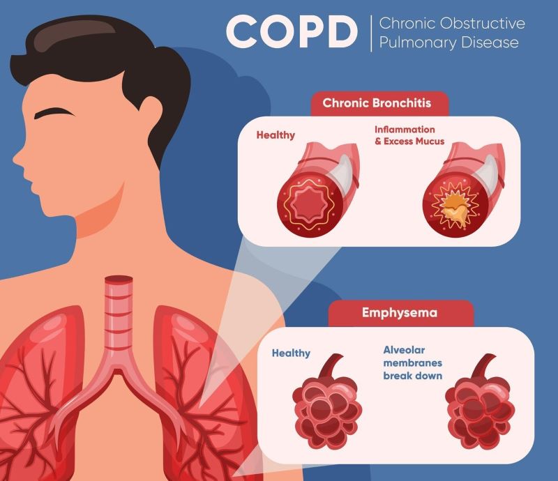 Bệnh COPD có thể là nguyên nhân dẫn đến tình trạng tích tụ CO2 trong phổi