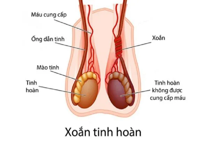 siêu âm xoắn tinh hoàn