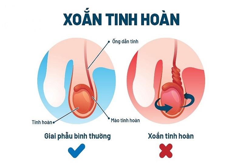 siêu âm xoắn tinh hoàn