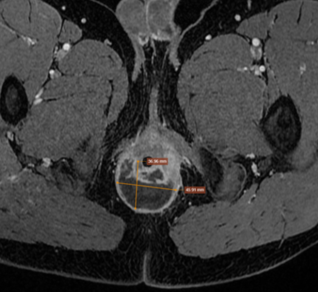 mri rò hậu môn